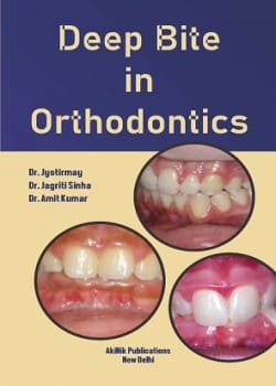 Deep Bite in Orthodontics